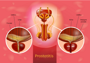 prostatitas