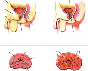 normalus prostatos ir lėtinis prostatitas