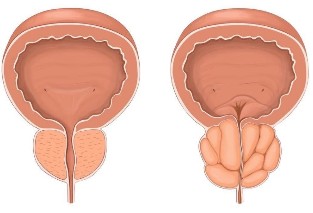 Prostatitas